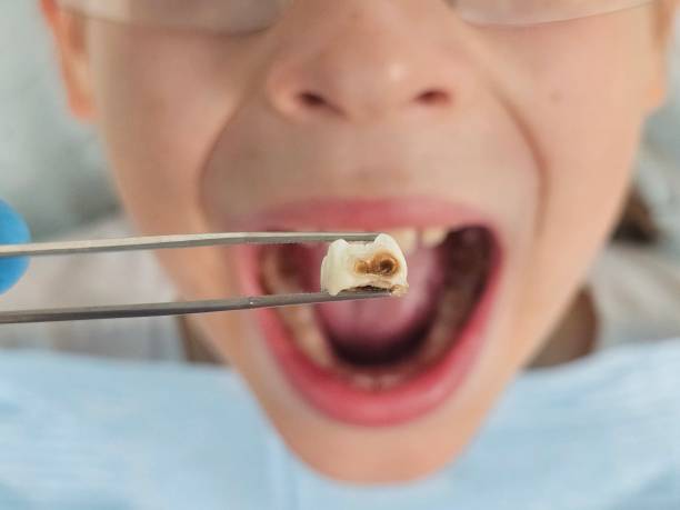 Best Chipped Tooth Repair Near Me  in Spring Mount, PA